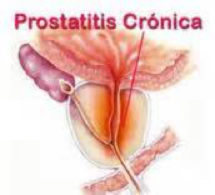 prostatitis bacteriana crónica